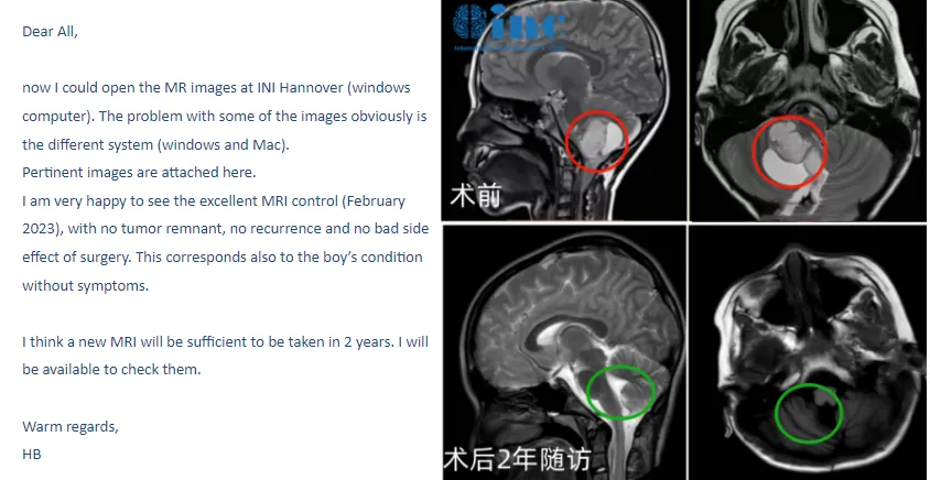 6歲男孩——小腦-腦干毛細胞星形細胞瘤