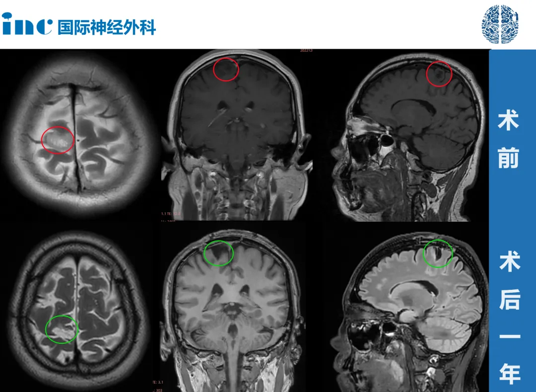 41歲女性——額葉低級別膠質瘤