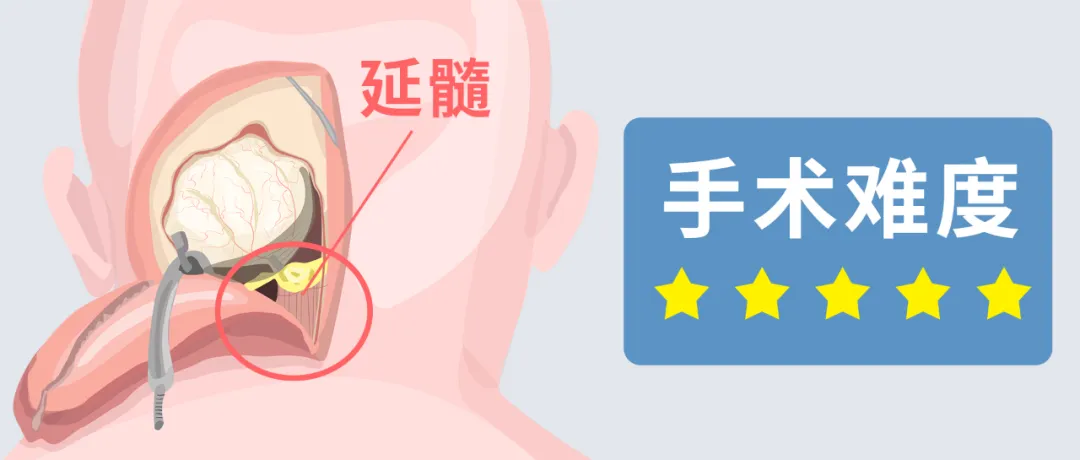 延髓腫瘤手術(shù)難度高