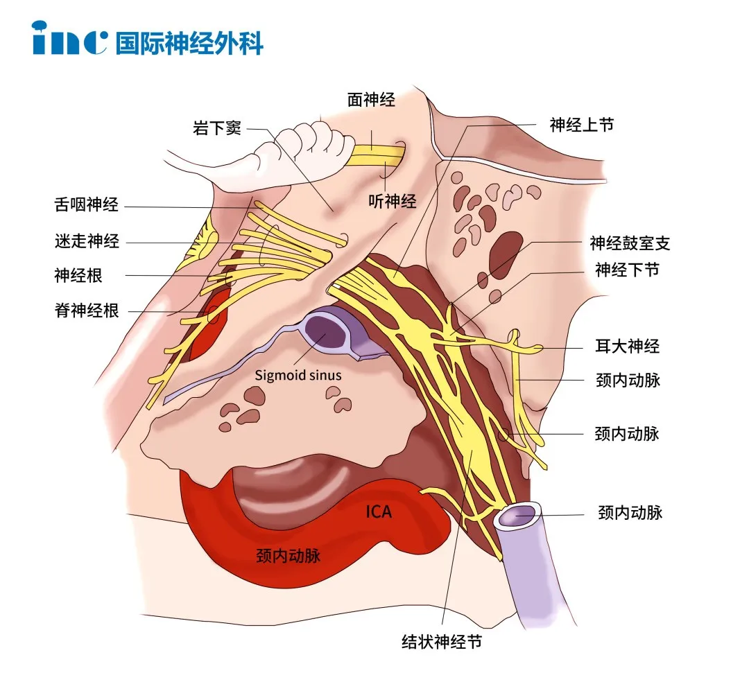 手術(shù)盡可能保護后組顱神經(jīng)，頸靜脈孔區(qū)復(fù)雜的神經(jīng)血管