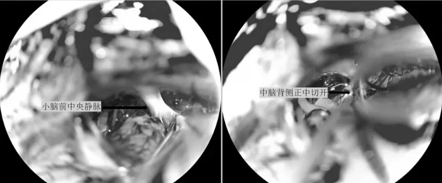切除腫瘤上部及第三腦室上部腫瘤