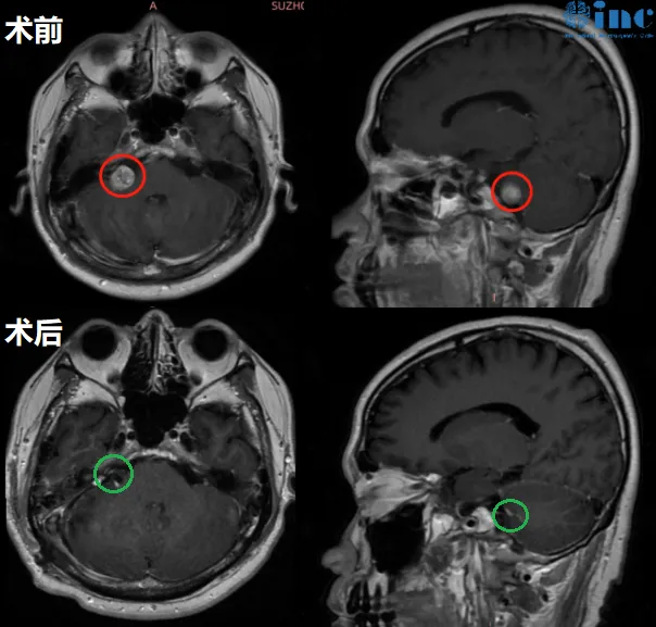 高先生案例：聽神經(jīng)瘤兩次突聾后，能否實現(xiàn)功能保全？