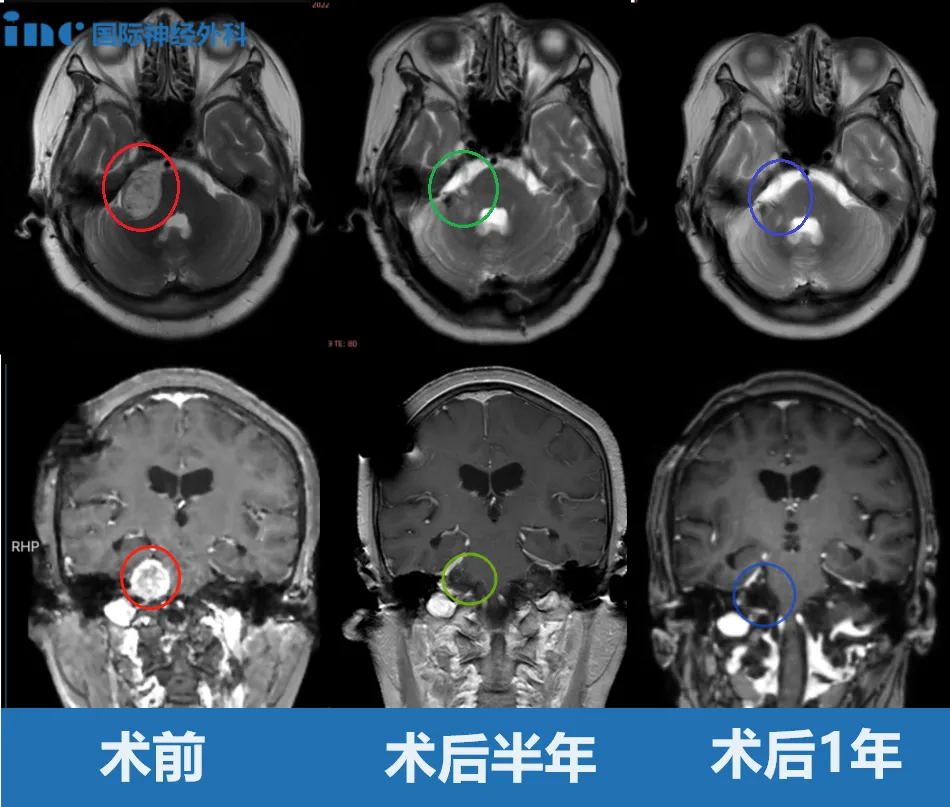 齊奶奶案例：老年人聽力下降需警惕聽神經(jīng)瘤壓迫腦干