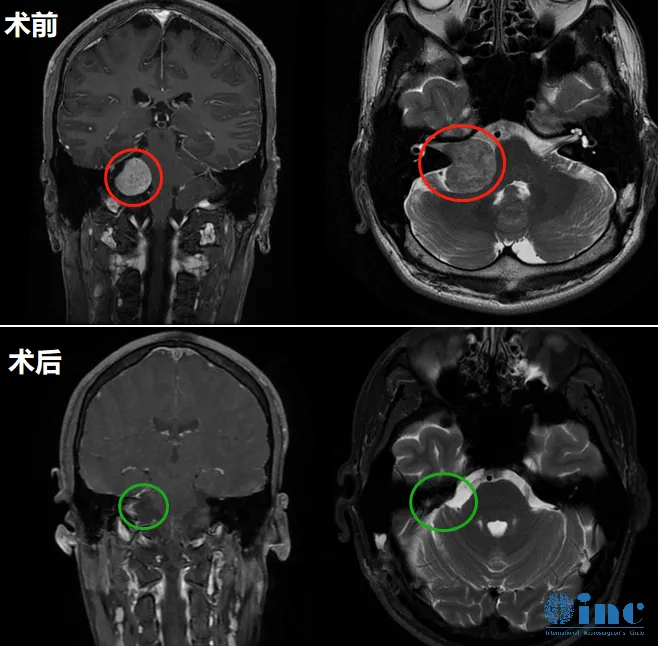 齊奶奶案例：老年人聽力下降需警惕聽神經(jīng)瘤壓迫腦干