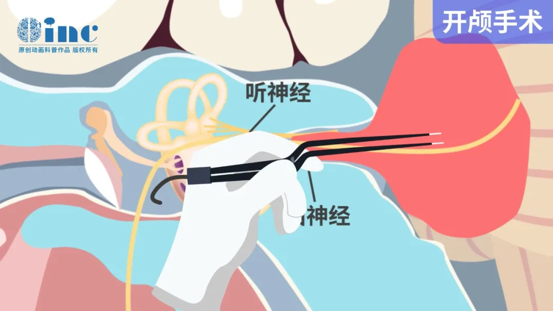 術(shù)中“面神經(jīng)燙傷”是怎么回事？
