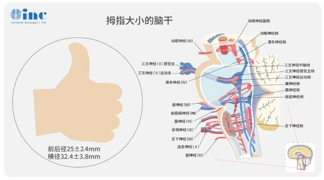 腦血管瘤案例圖片