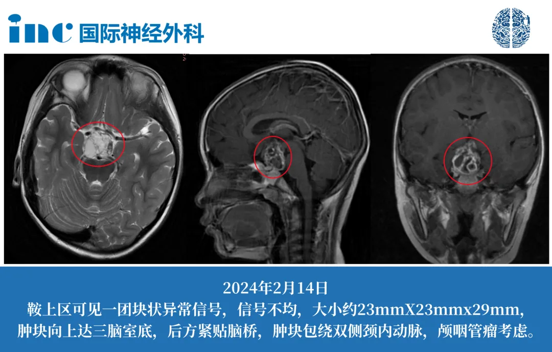 顱咽管瘤典型癥狀解析：發(fā)育遲緩和視力模糊等