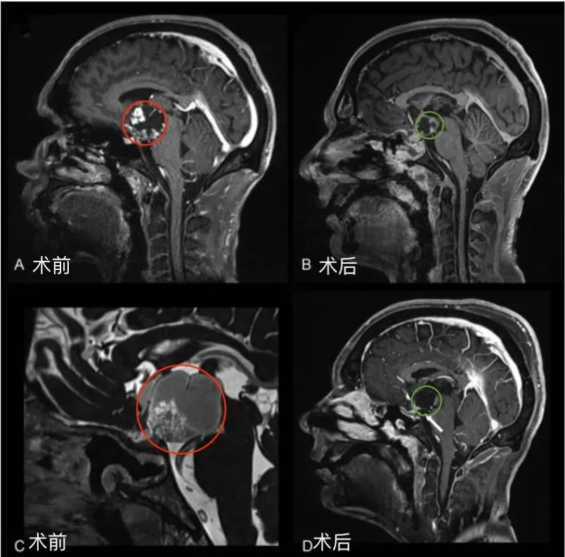 福洛里希教授采用單鼻孔經(jīng)鼻內(nèi)鏡及顯微鏡開顱手術(shù)，在最大程度地保護(hù)神經(jīng)功能的基礎(chǔ)上，實現(xiàn)了腫瘤的安全全切。