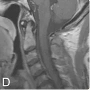 手術(shù)實現(xiàn)了全切除，術(shù)后 MRI 顯示未見殘留腫瘤或強化