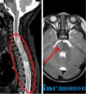 教授回復(fù)：在靶向治療期間神經(jīng)系統(tǒng)癥狀似乎在逐漸惡化，所以我認(rèn)為要么換一種新的靶向藥物，要么就該考慮手術(shù)?，F(xiàn)在腿部不能動(dòng)，部分原因是因?yàn)榧顾枋艿侥[瘤的壓力。必須通過(guò)手術(shù)緩解部分壓力，脊髓功能才可能恢復(fù)。我們應(yīng)當(dāng)采取 “安全 + 有效”的手術(shù)策略，結(jié)合術(shù)后病理結(jié)果制定新的靶向治療。我不建議等待太久，建議在接下來(lái)一到三個(gè)月內(nèi)進(jìn)行手術(shù)。我認(rèn)為手術(shù)和靶向治療聯(lián)合使用，有可能帶來(lái)恢復(fù)。