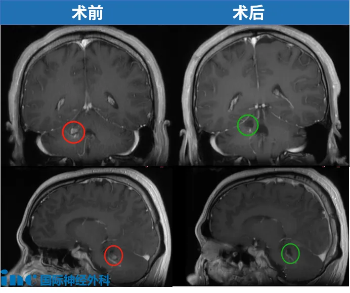 術(shù)前術(shù)后MRI對(duì)比