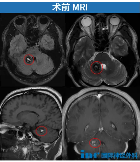 術(shù)前MRI