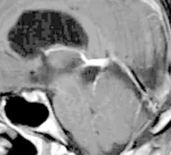 術(shù)后MRI