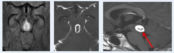術(shù)前MRI