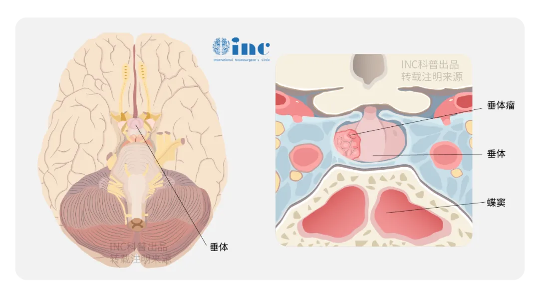 無論采用何種手術(shù)方式，再次手術(shù)的全切除率(GTR)都低于第一次手術(shù)